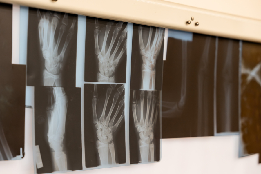 A series of x-rays on a light panel in the kinesiology laboratory at the University of Portland.